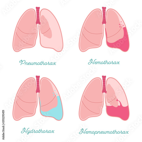 Some types of pleural effusions. Abnormal gathering fluid or air pleural space. Hemothorax, pneumothorax, hemopneumothorax and hydrothorax also. Comparative scheme for patients or medical students