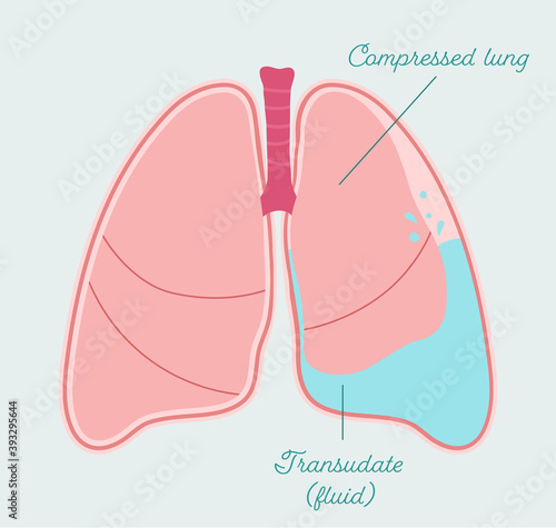 Hydrothorax - anatomical scheme in hand drawn style. Accumulation of transudate fluid in pleural cavity, type of pleural effusion. Patient-friendly infographic, vector medical scheme