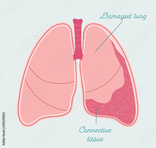 Fibrothorax - anatomical scheme in hand drawn style. Fibrosis in pleural cavity, abnormal scarring of pleural space. Patient-friendly infographic, vector medical scheme