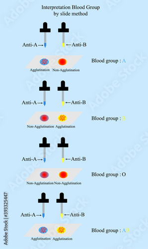 Interpretation blood group in ABO System by slide method in laboratory