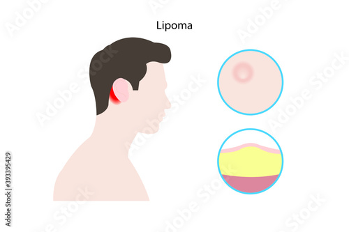 A lipoma is a lump under the skin that occurs due to an overgrowth of fat cells. Doctors consider lipomas to be benign tumors. photo