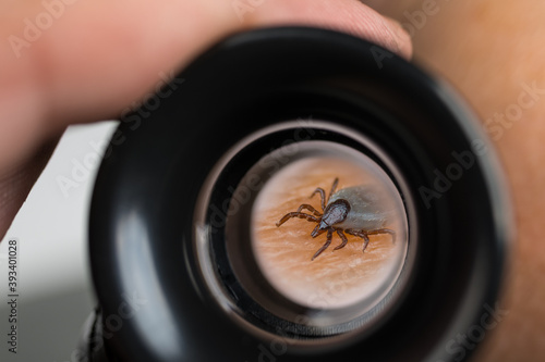 Dangerous deer tick on human skin in magnifying glass of black eyepiece. Ixodes ricinus. Small parasitic mite detail zoomed in by magnifier. Tickborne diseases. Prevention or medical research concept.