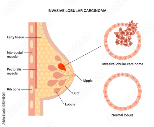 Breast disease concept