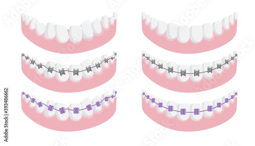 Lower jaw with healthy tooth and dental brace set. All type of metal, ceramic and invisible lingual orthodontic bracket system for teeth correction vector illustration isolated on white background
