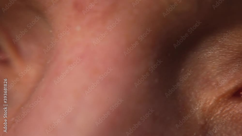 Close-up of a man's irritated eye. Dry mucous membrane in windy weather. Study of the pupil of the eye. Handheld shooting, shaking. Close-up of a man's irritated eye. Dry mucous membrane in windy weather. Study of the pupil of the eye. Handheld shooting, shaking.
