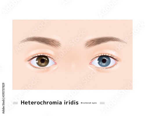 オッドアイ 瞳 目 女性 色 二色 虹彩 まぶた 眉毛 瞳孔 虹彩異色症 イラスト リアル Stock Vector Adobe Stock オッドアイ 瞳 目 女性 色 二色 虹彩 まぶた 眉毛 瞳孔 虹彩異色症 イラスト リアル Stock Vector Adobe Stock