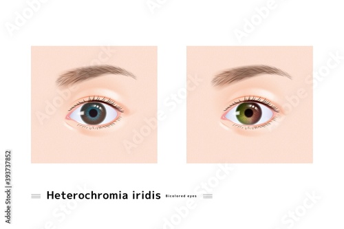  オッドアイ 瞳 目 女性 色 二色 虹彩 まぶた 眉毛 瞳孔 虹彩異色症 イラスト リアル 
