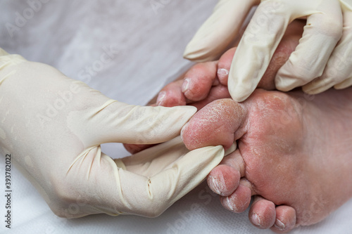 Problematic diabetic foot in a woman. Dry skin on the sole and cracked toes. Medical hardware pedicure in the salon.