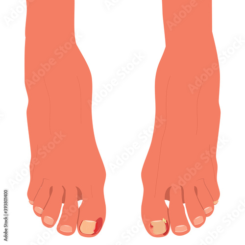 Feet with ingrown toenails.Disease, fungus or inflammation in fingernails. Legs problem area with pus and blood.Right pedicure,body care.Onychomycosis, paronychia sickness.Vector in flat style