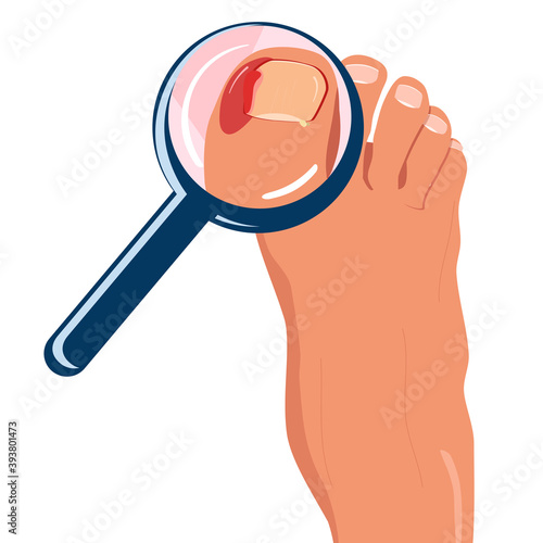 Foot with ingrown toenail.Disease, fungus or inflammation in fingernails. Magnifying glass zooming problem area with pus and blood.Right pedicure,body care.Onychomycosis, paronychia sickness.Vector