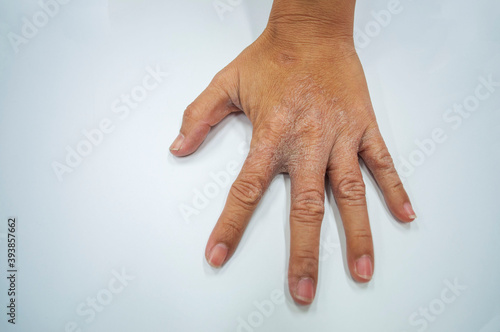 Hands with fungal skin lesions on white.Skin diseases caused by fungi