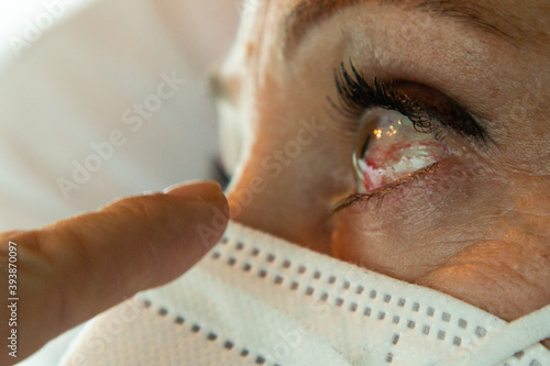 Ojo rojo de una paciente con conjuntivitis y dedo indicando la lesión photo