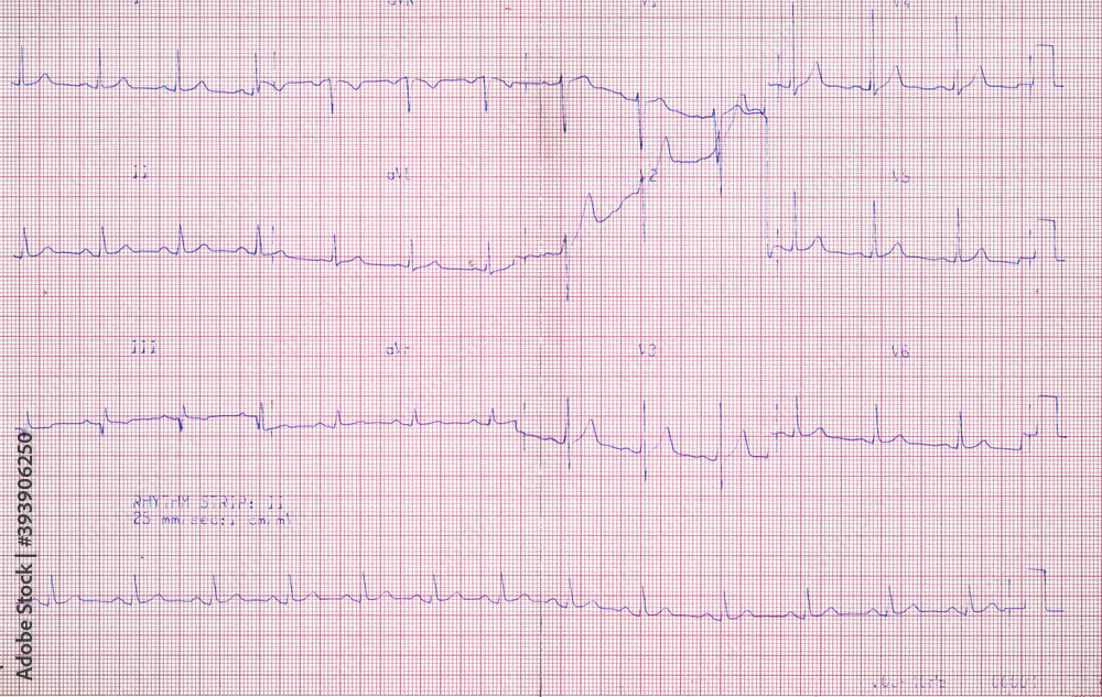 A real chart of an ECG (electrocardiogram, a trace, registered on paper, of the heart's electrical activity).
