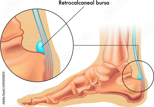 Illustration showing the position of the retrocalcaneal bursa in the foot, with an enlarged detail, and annotation. photo