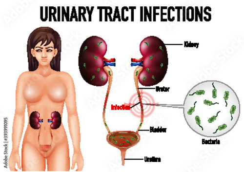 Informative illustration of urinary tract infections