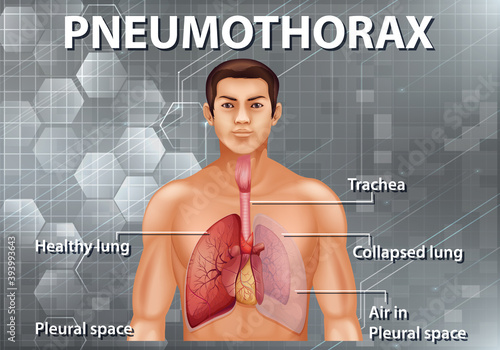 Human anatomy Pneumothorax diagram
