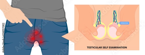 Testicular Disorder men vas pus tube male pain cyst test exam self cord vein sperm Acute blood semen tract penis viral virus tumor fluid testes pelvic sexual penile trauma system prostate testis