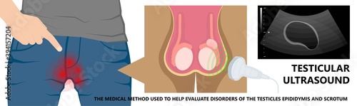 Testicular Disorder men vas pus tube male pain cyst test exam self cord vein sperm Acute blood semen tract penis viral virus tumor fluid testes pelvic sexual penile trauma system prostate testis