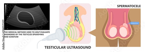 Testicular Disorder men vas pus tube male pain cyst test exam self cord vein sperm Acute blood semen tract penis viral virus tumor fluid testes pelvic sexual penile trauma system prostate testis
