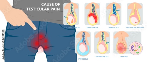 Testicular Disorder men vas pus tube male pain cyst test exam self cord vein sperm Acute blood semen tract penis viral virus tumor fluid testes pelvic sexual penile trauma system prostate testis