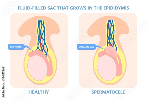 Testicular Disorder men vas pus tube male pain cyst test exam self cord vein sperm Acute blood semen tract penis viral virus tumor fluid testes pelvic sexual penile trauma system prostate testis