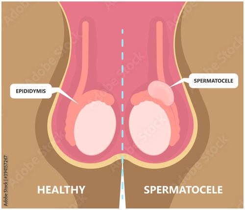 Testicular Disorder men vas pus tube male pain cyst test exam self cord vein sperm Acute blood semen tract penis viral virus tumor fluid testes pelvic sexual penile trauma system prostate testis