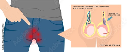 Testicular Disorder men vas pus tube male pain cyst test exam self cord vein sperm Acute blood semen tract penis viral virus tumor fluid testes pelvic sexual penile trauma system prostate testis