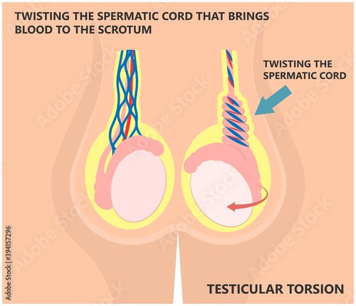 Testicular Disorder men vas pus tube male pain cyst test exam self cord vein sperm Acute blood semen tract penis viral virus tumor fluid testes pelvic sexual penile trauma system prostate testis