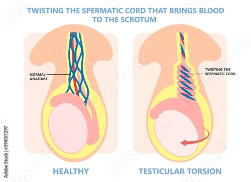 Testicular Disorder men vas pus tube male pain cyst test exam self cord vein sperm Acute blood semen tract penis viral virus tumor fluid testes pelvic sexual penile trauma system prostate testis