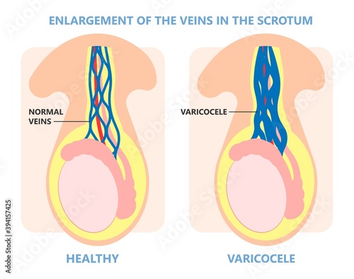 Testicular Disorder men vas pus tube male pain cyst test exam self cord vein sperm Acute blood semen tract penis viral virus tumor fluid testes pelvic sexual penile trauma system prostate testis