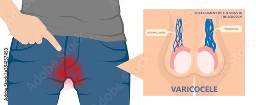 Testicular Disorder men vas pus tube male pain cyst test exam self cord vein sperm Acute blood semen tract penis viral virus tumor fluid testes pelvic sexual penile trauma system prostate testis