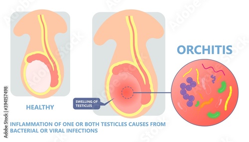 Testicular Disorder men vas pus tube male pain cyst test exam self cord vein sperm Acute blood semen tract penis viral virus tumor fluid testes pelvic sexual penile trauma system prostate testis