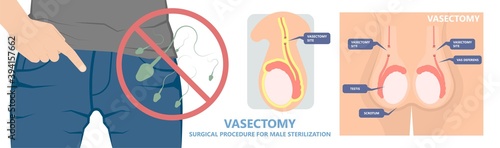 Vasectomy male sterilisation Ejaculate contraceptive genitalia sterilisation operation method medical genital cut system