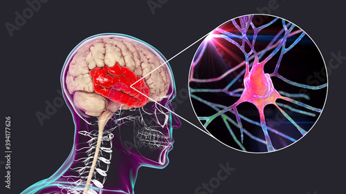 Human brain with highlighted temporal lobe and close-up view of neurons photo