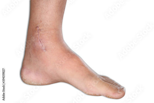 Picture of injured ankle patient falling from heights have severe sprains fractures broken born ligament tears new operation with clipping path shadow isolated white background  © Kings Access