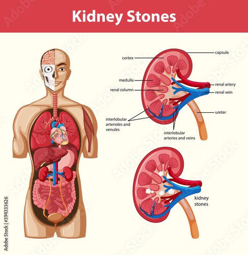 Human kidney stones anatomy cartoon style infographic