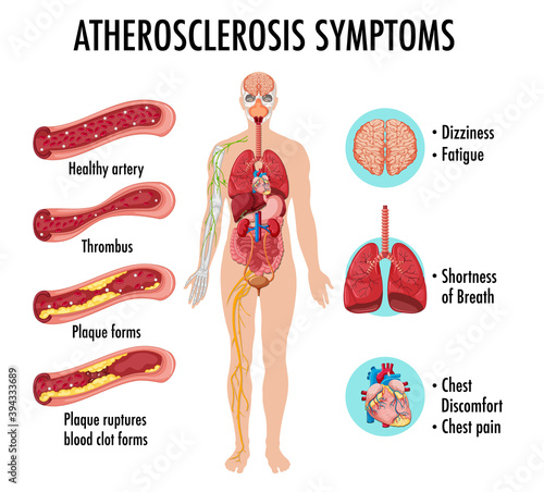 Stages of atherosclerosis information infographic