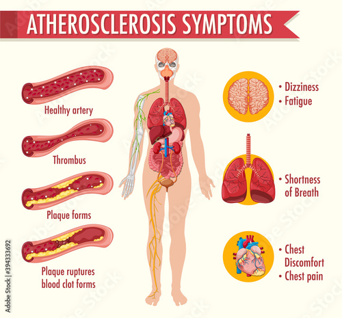 Stages of atherosclerosis information infographic