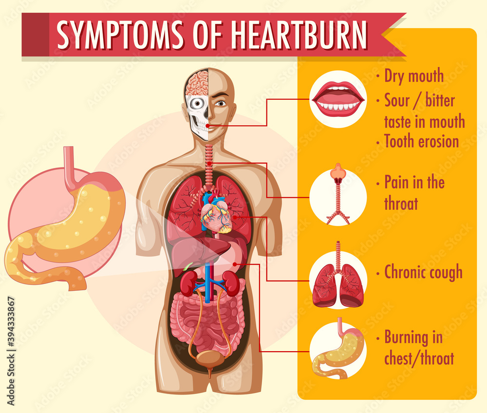 Symptoms of heartburn information infographic Stock Vector | Adobe Stock