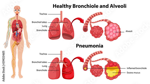 Healthy and unhealthy of human lungs