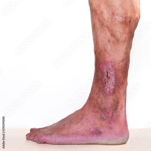 Phlebeurysm