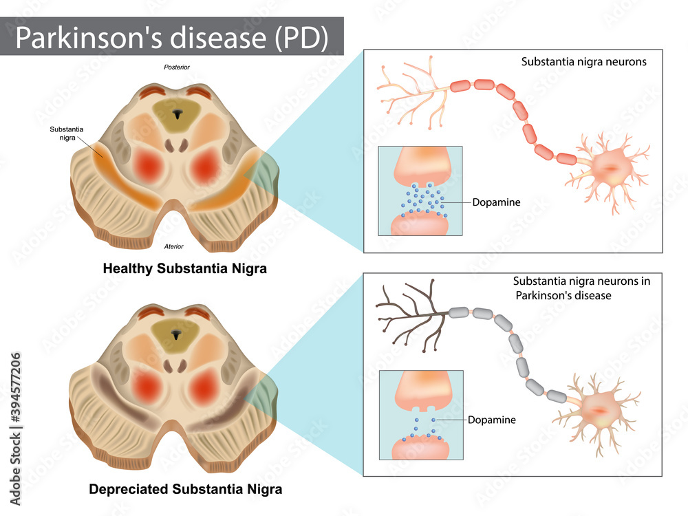 Parkinson s disease PD . Normal and Depreciated Substantia Nigra Stock