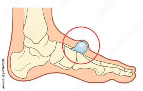 Ganglion foot cyst illustration