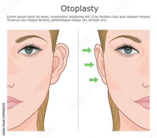Otoplasty ear correction surgery illustration