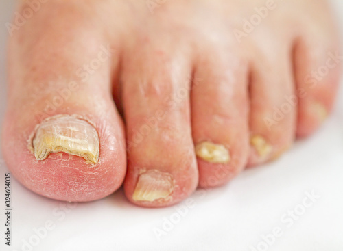 Tableau sur toile old fingernail