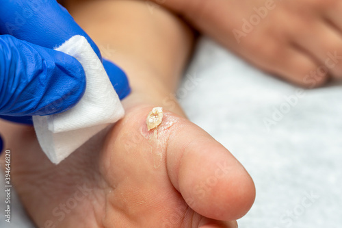 Healing treatment of cracked, dry wart, calluses on the child foot sole photo