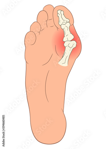 Hallux valgus foot deformation