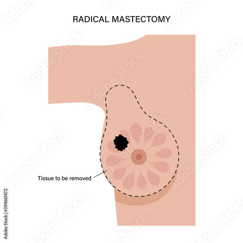 Breast disease concept