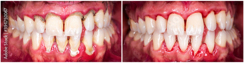 teeth tartar and caculus cleaning