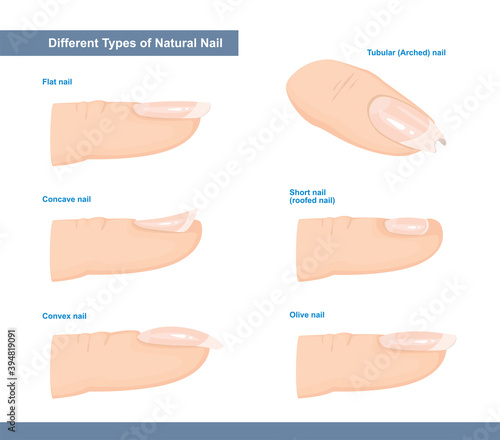 Different Types of Fingernail. Normal, Short, Roofed, Tubular, Arched, Flat, Convex and Concave Nails. Nail Extension Guide. Vector Illustration photo